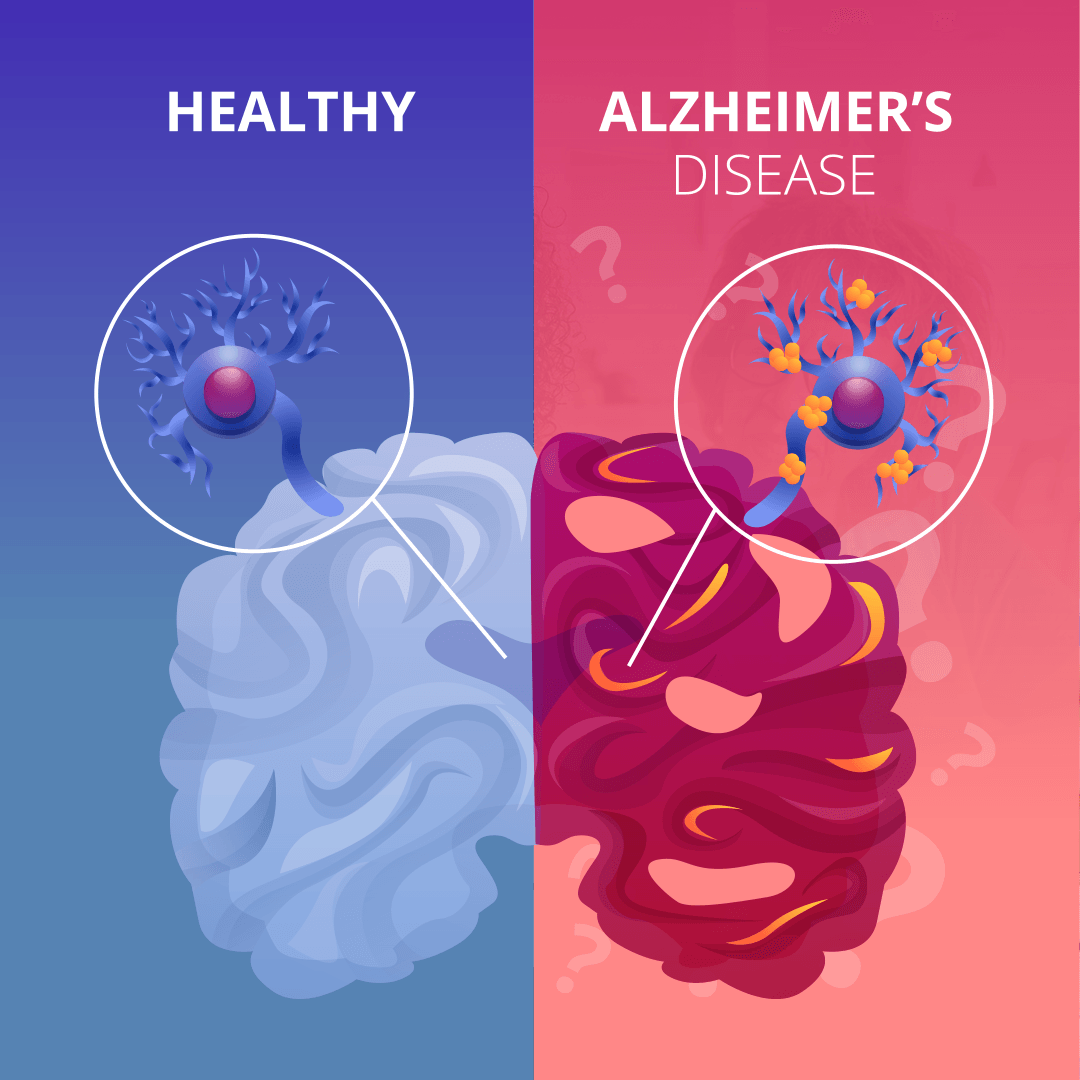 Alzheimer's