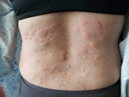 Anaphylaxis