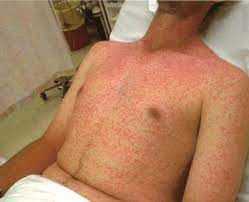 Anaphylaxis