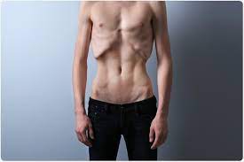 Anorexia Nervosa