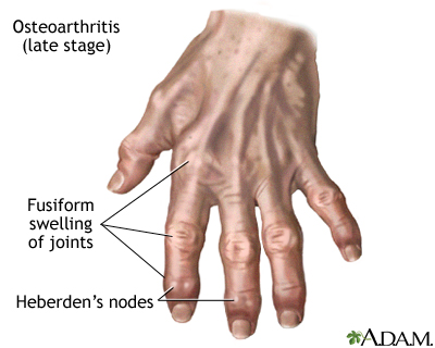 Arthritis