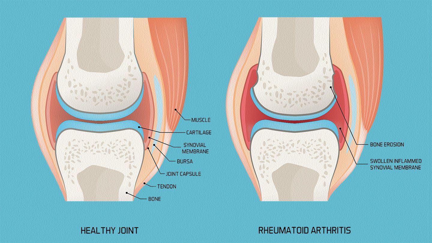 Arthritis
