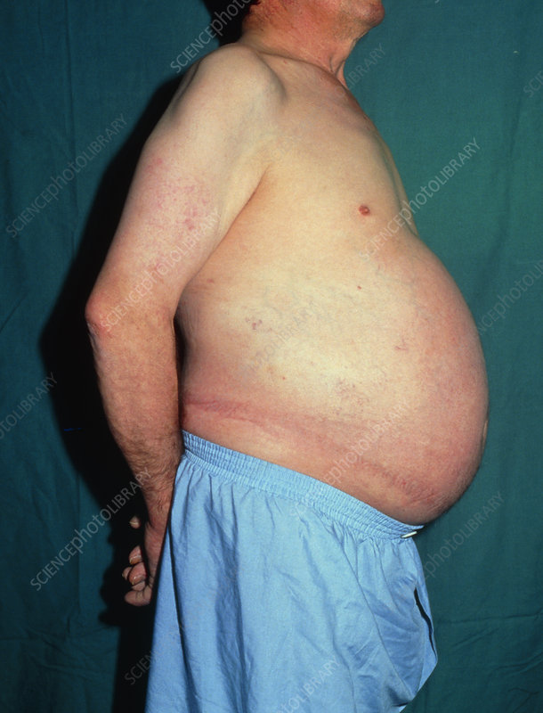 Ascites