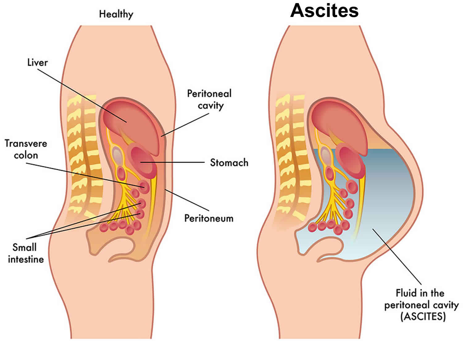 Ascites