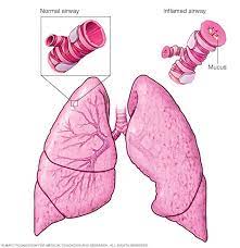 Asthma