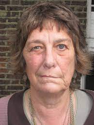 Bell's palsy