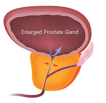 Benign prostatic hyperplasia