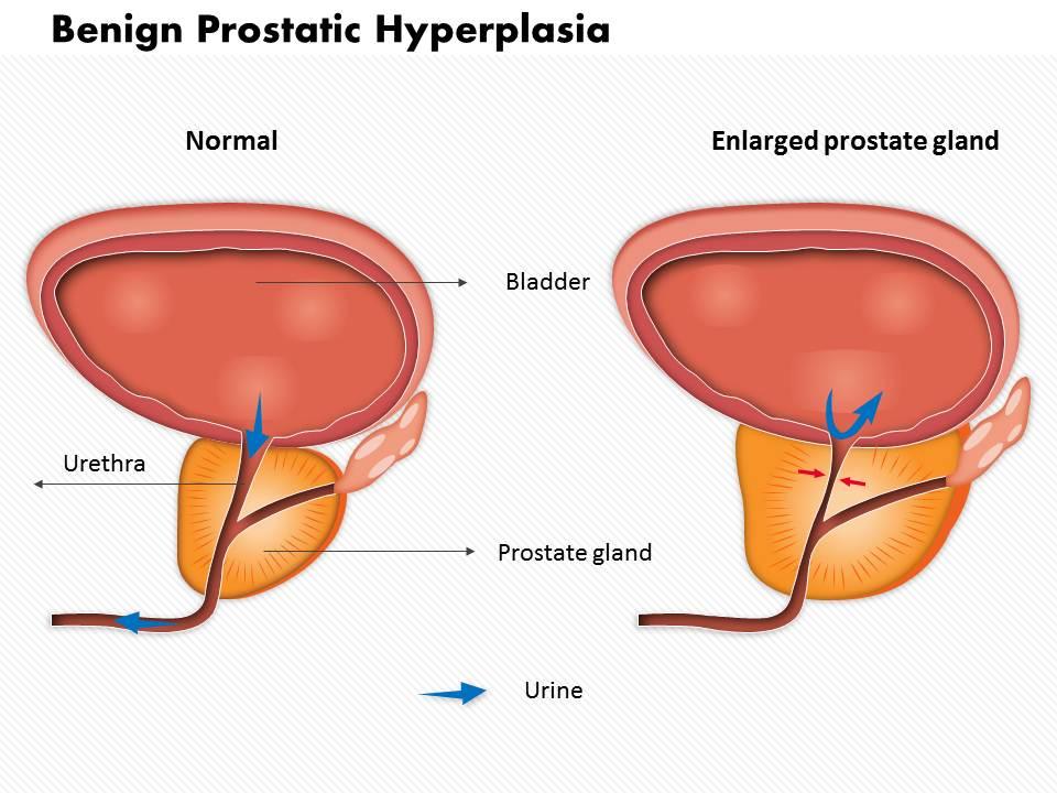 Benign prostatic hyperplasia