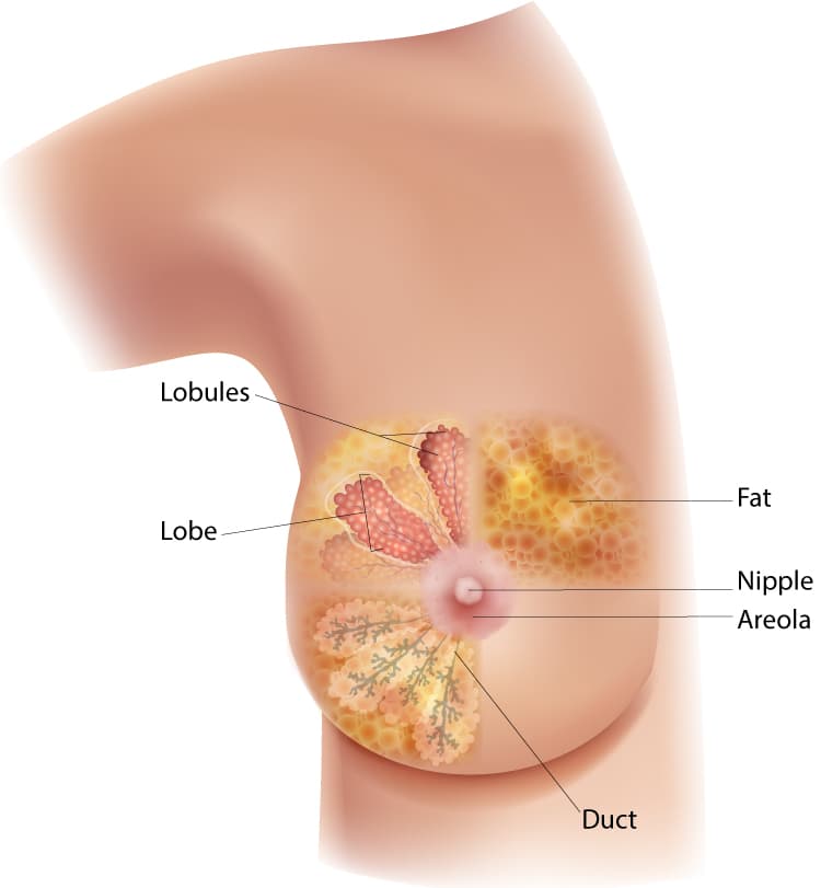 Breast cancer