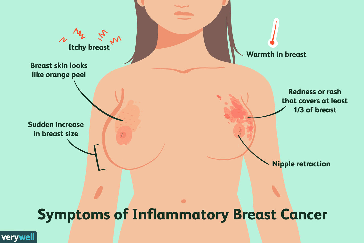 Breast cancer
