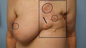 Breast cancer