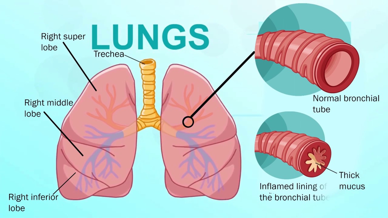Bronchitis
