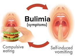 Bulimia nervosa