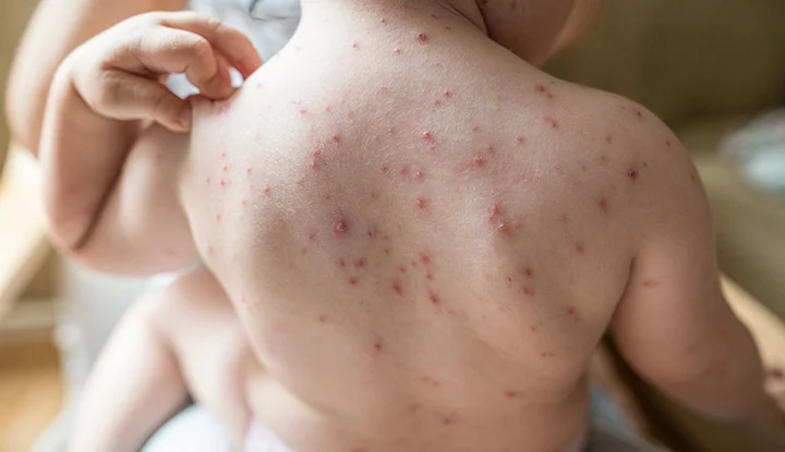 Chickenpox
