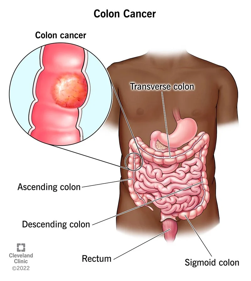 Colon cancer