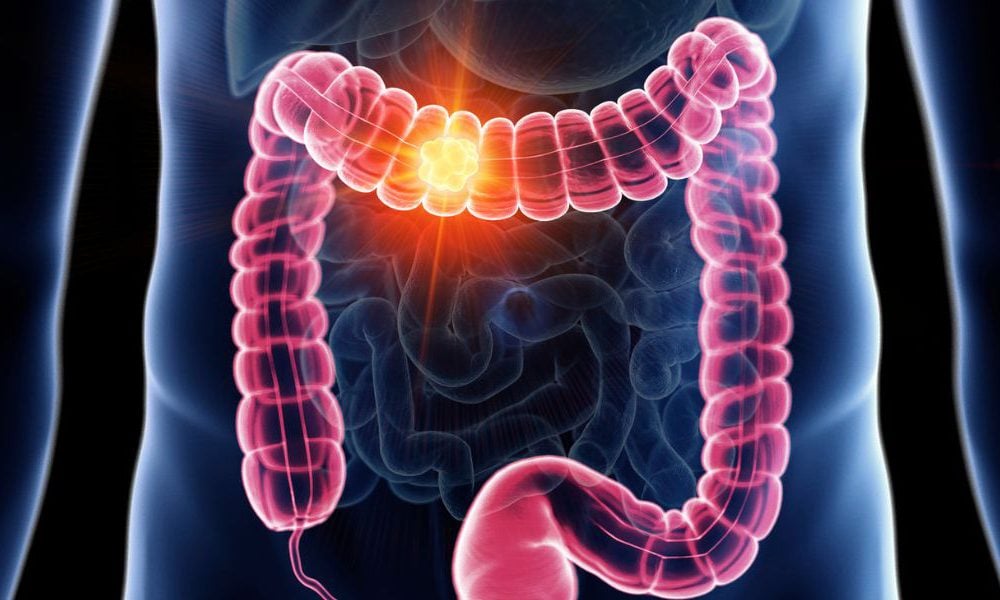 Colon cancer