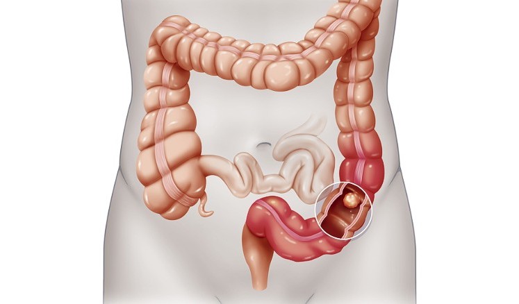 Colon cancer