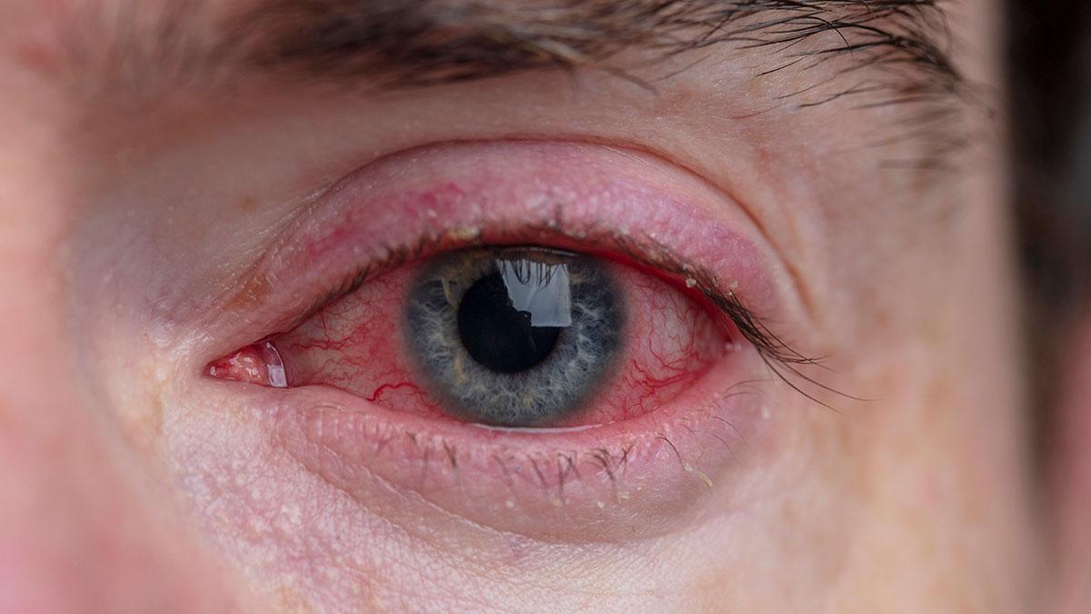 Conjunctivitis