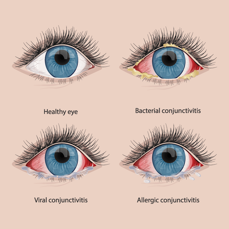 Conjunctivitis