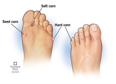 Corns