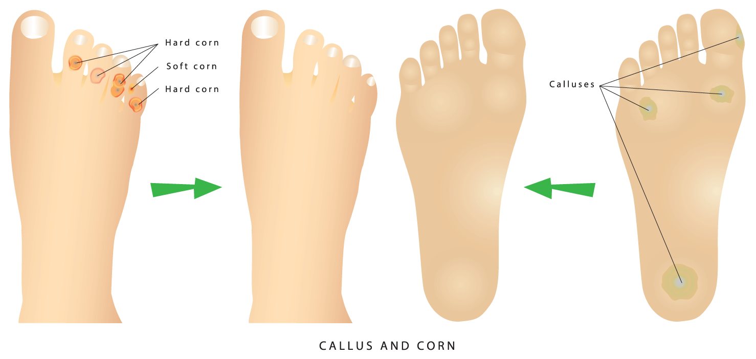 Corns