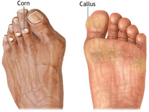 Corns