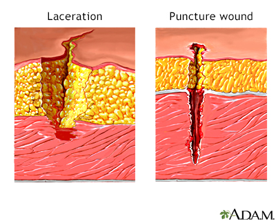 Cuts and puncture wounds