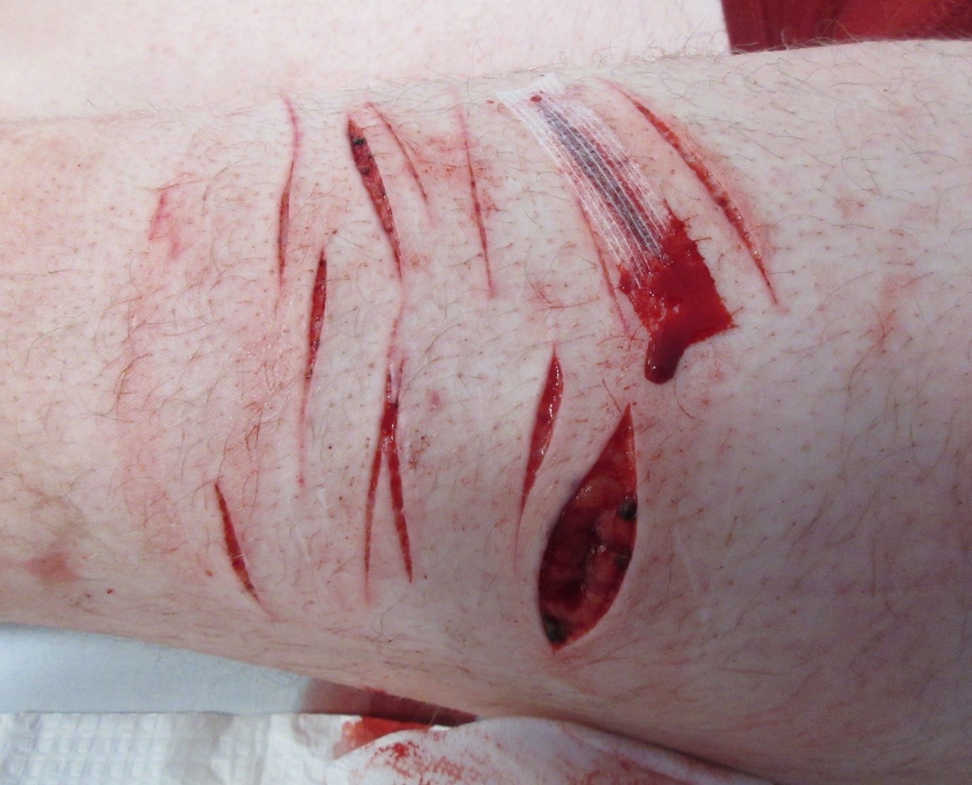 Cuts and puncture wounds