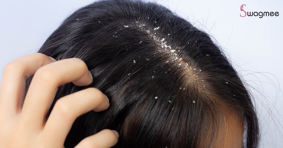 Dandruff