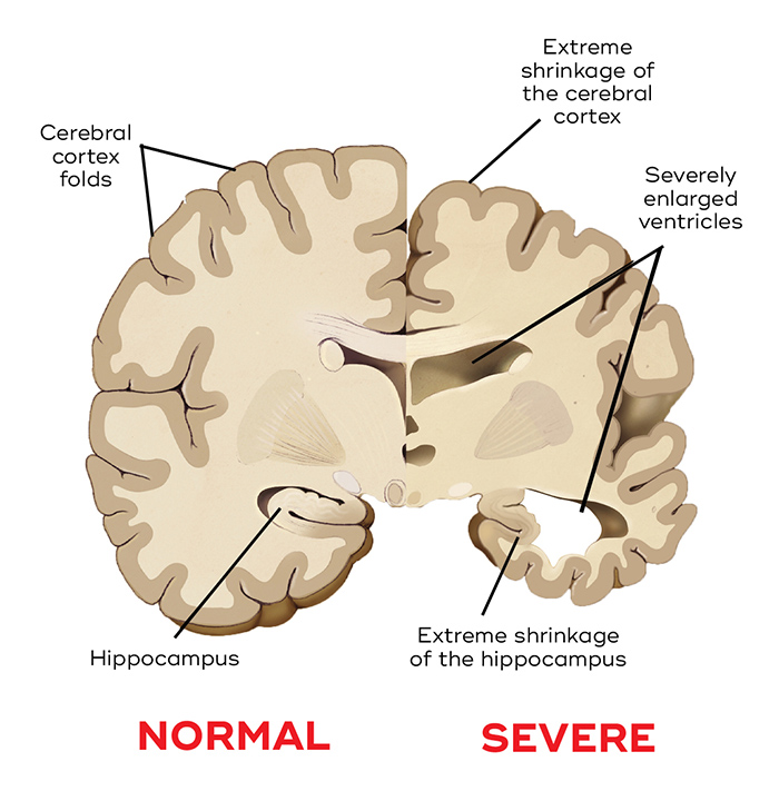 Dementia
