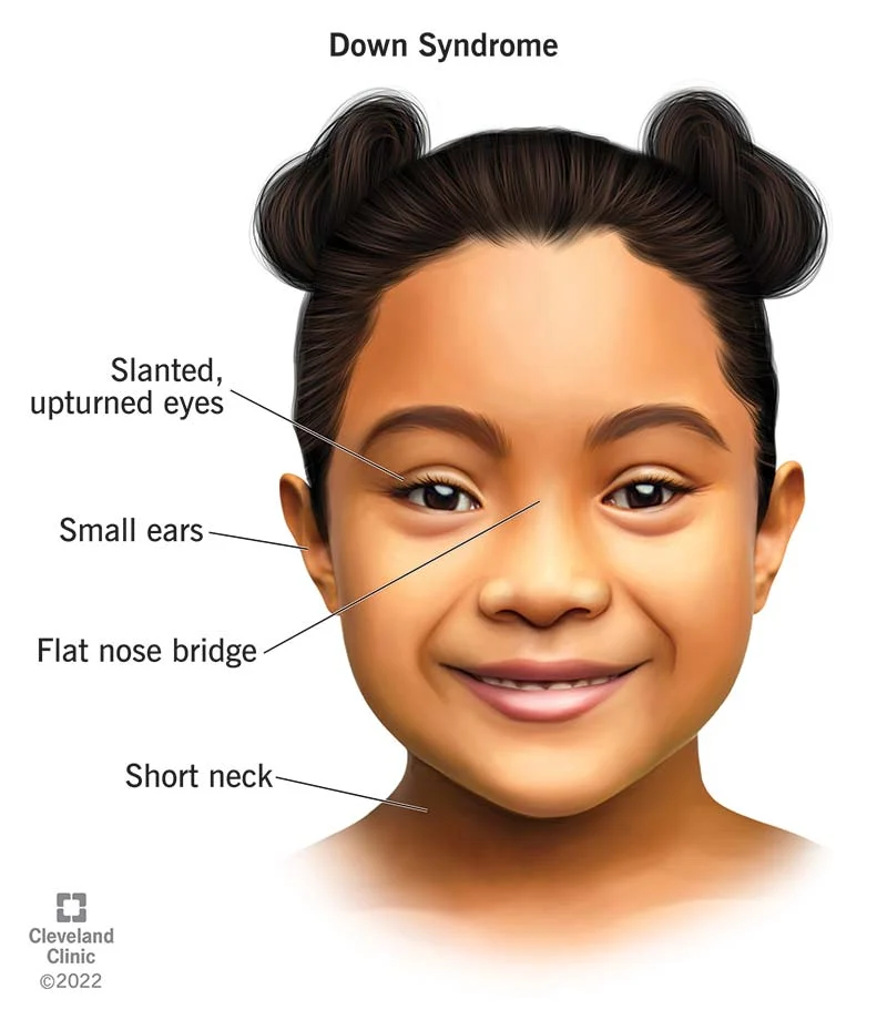 Down syndrome