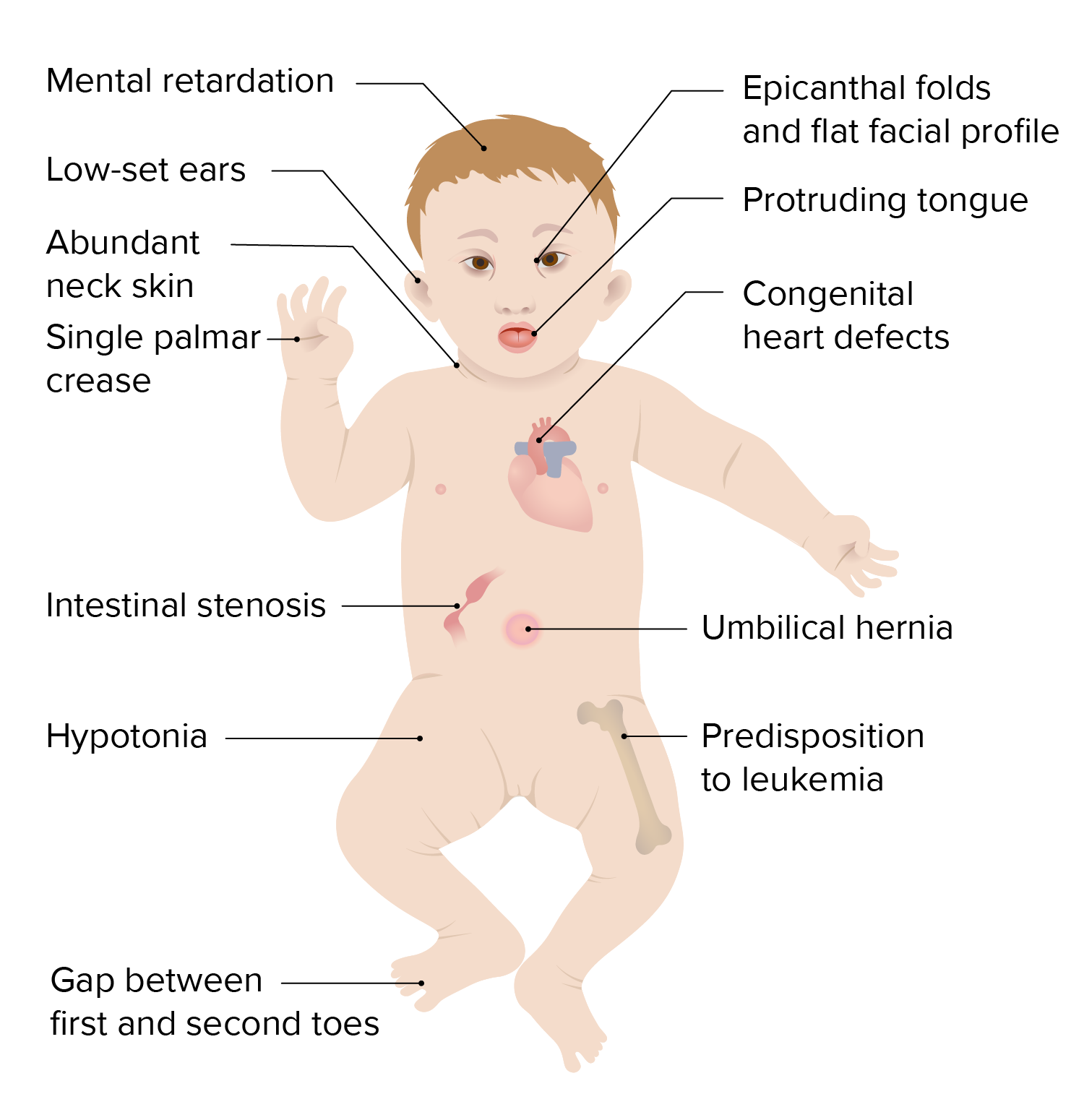 Down syndrome