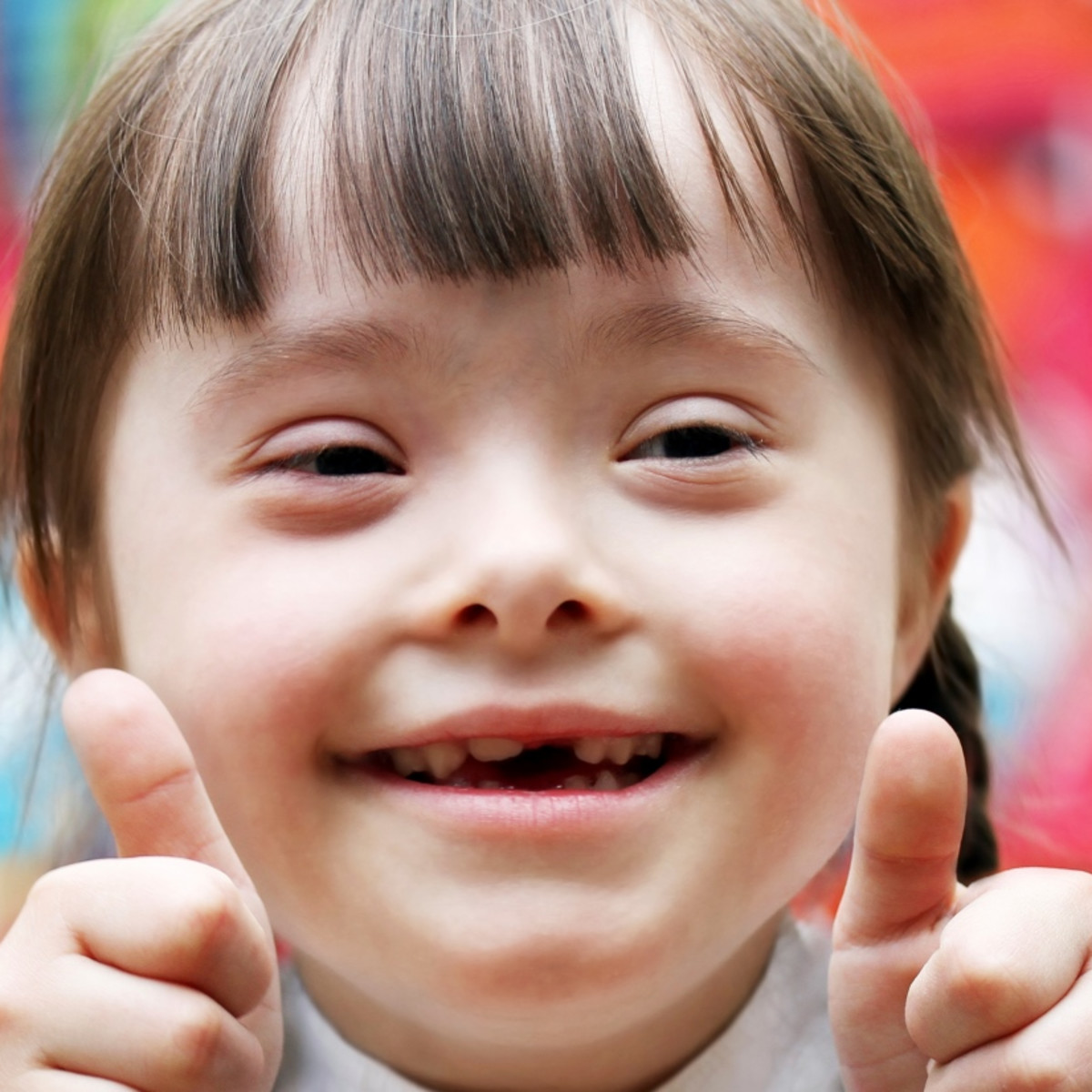 Down syndrome