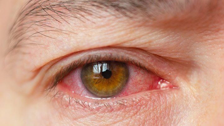 Dry eyes