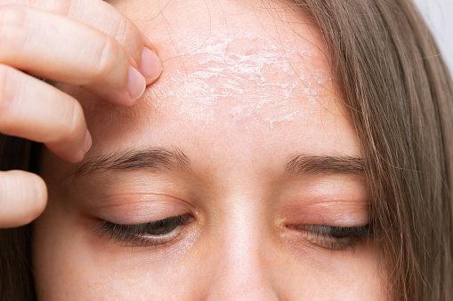 Dry Skin