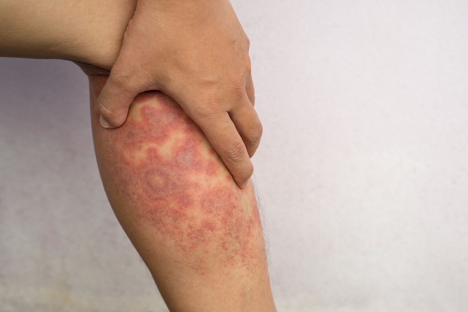 Eczema