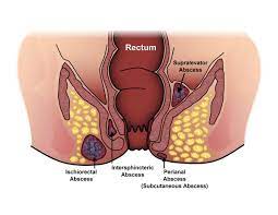 Fistula