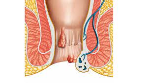 Fistula