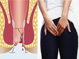 Fistula