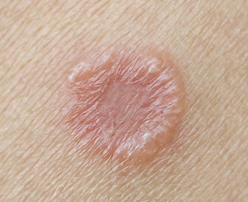 Fungal skin infections