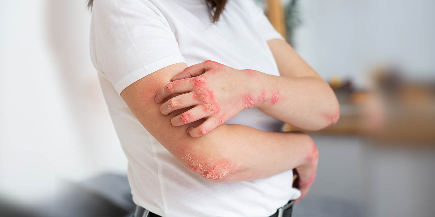 Fungal skin infections