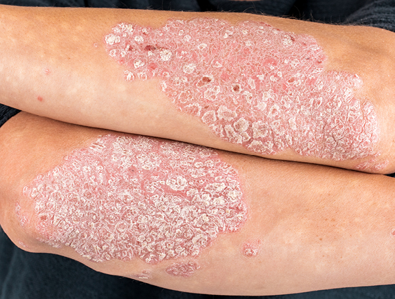 Fungal skin infections