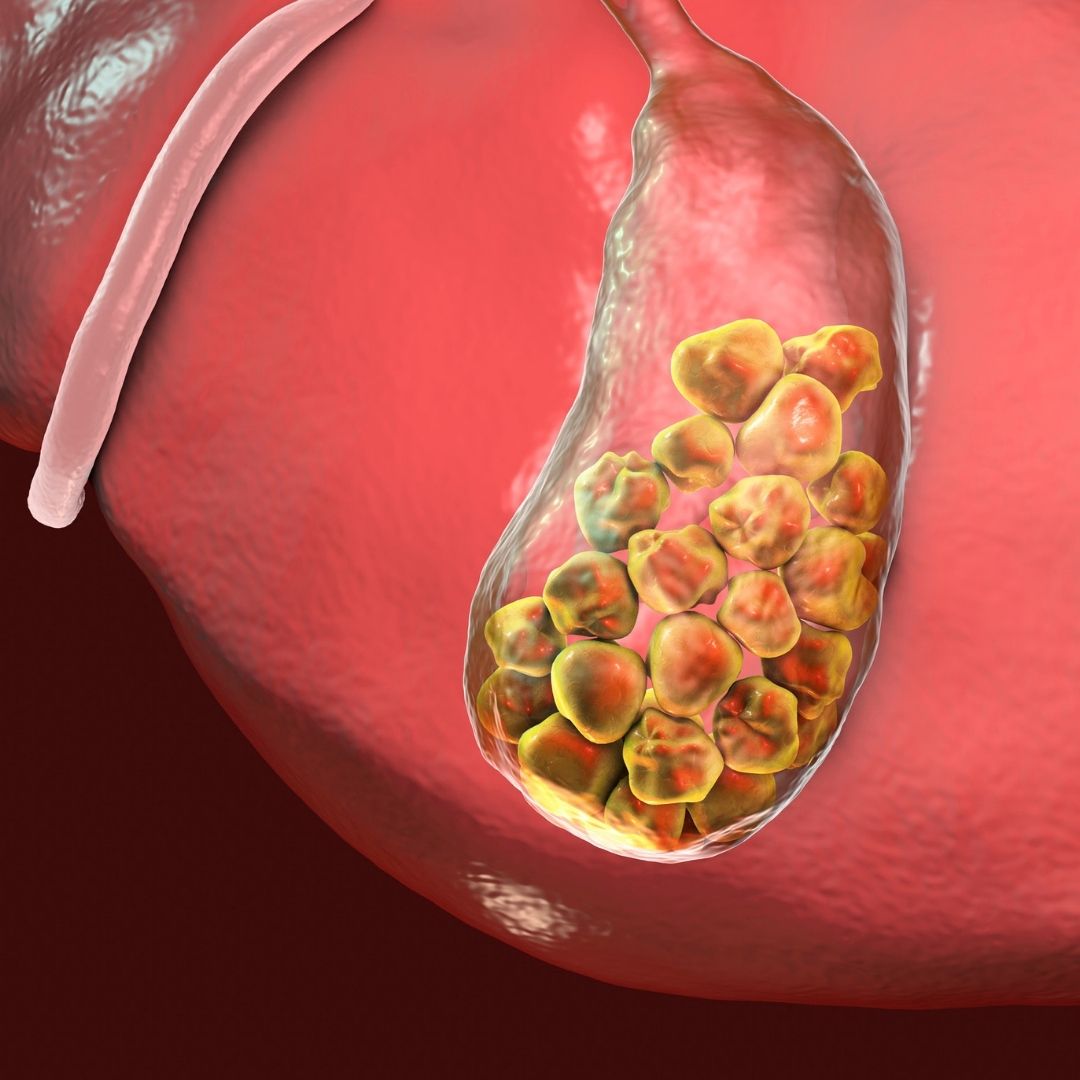 Gallbladder stones