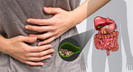 Gallbladder stones