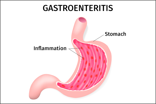 Gastroenteritis