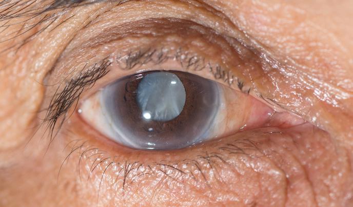 Glaucoma