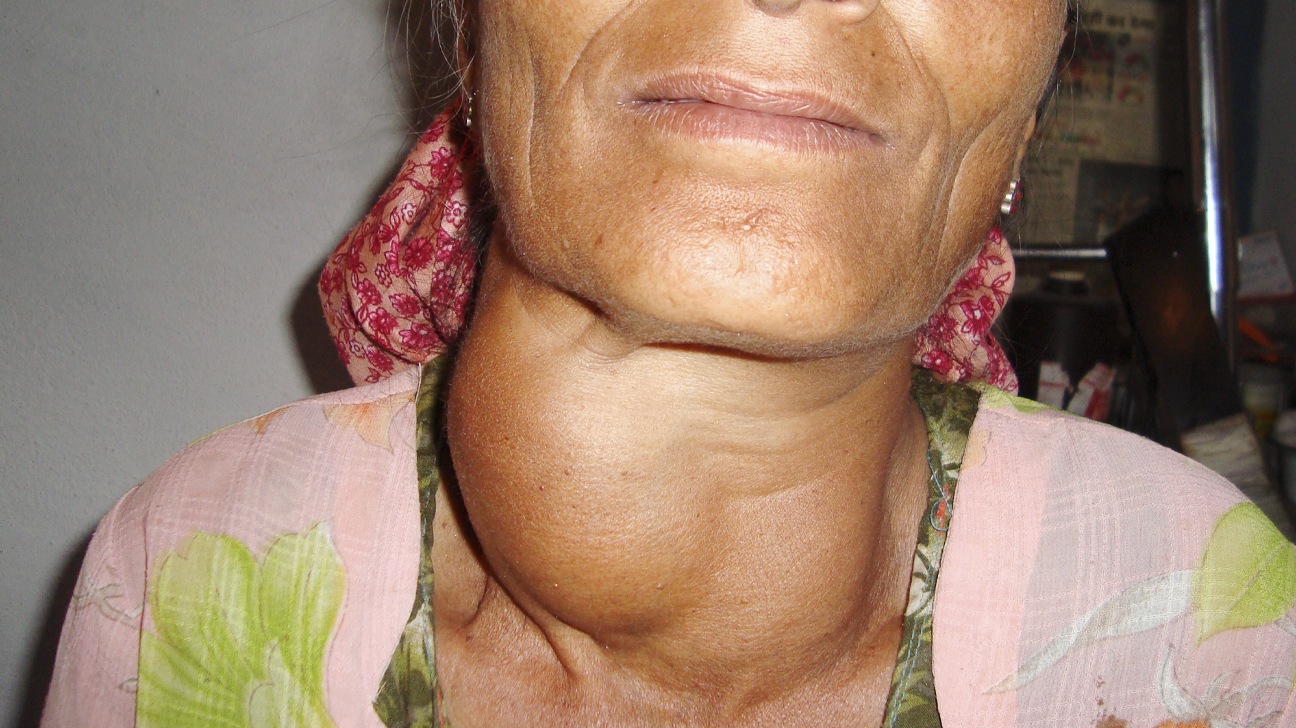 Goiter
