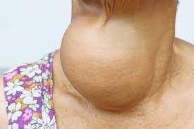 Goiter