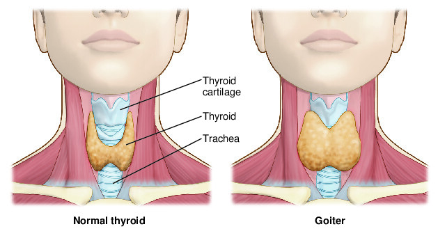 Goiter