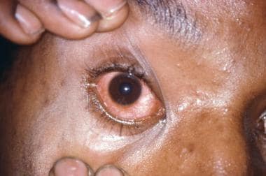 Gonorrhea